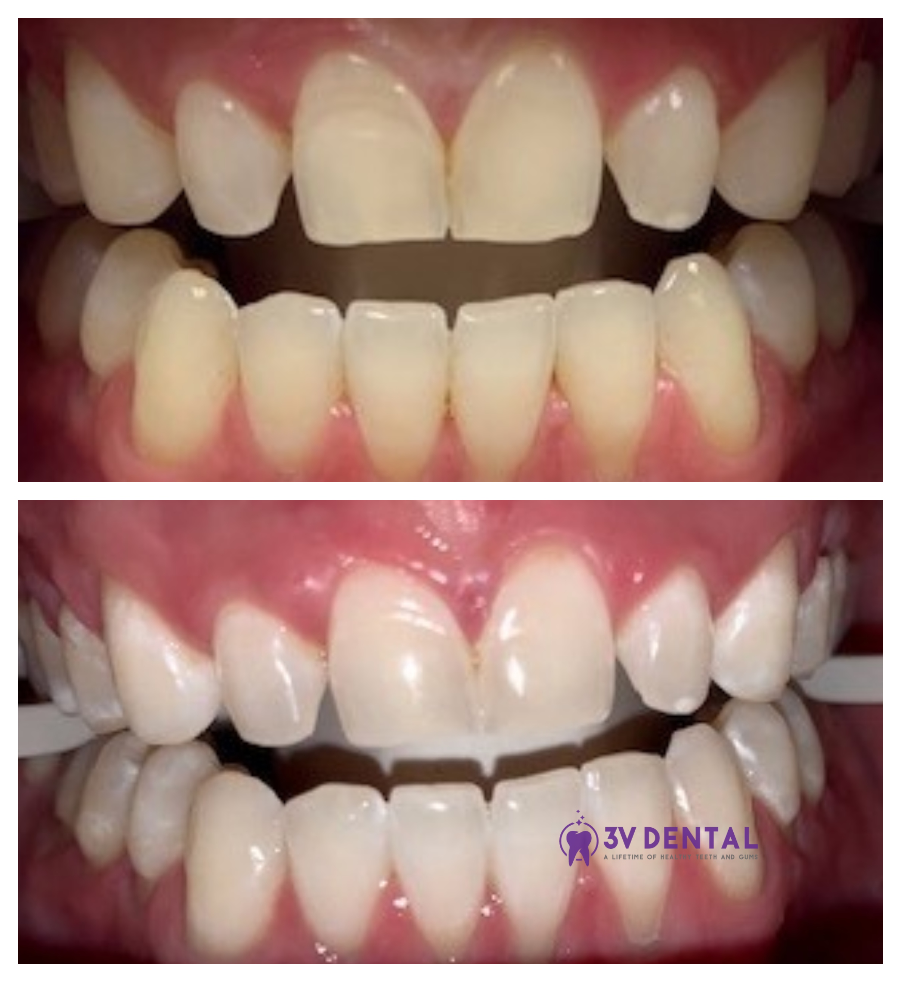 patchy teeth after zoom whitening