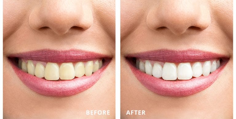 smile makeover 3v dental associates port washington ny
