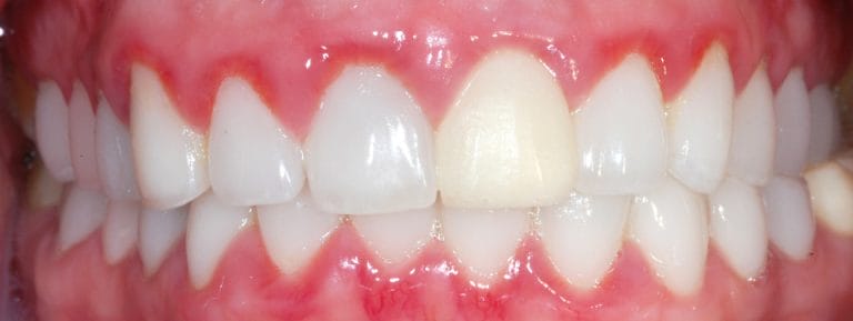 gingivitis-Treatments dentist port washington ny