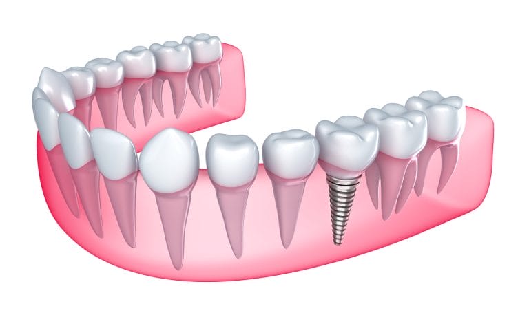 what are dental implants dentist port washington ny