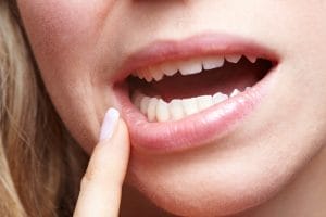 fix chipped or cracked tooth