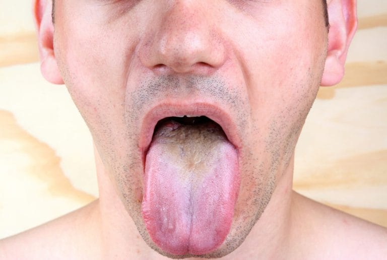 what does it mean if my tongue is color