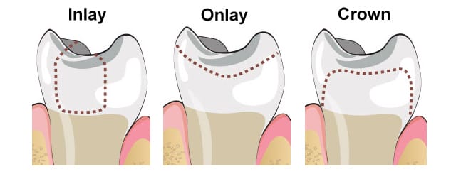 dental inlays and onlays port washington ny