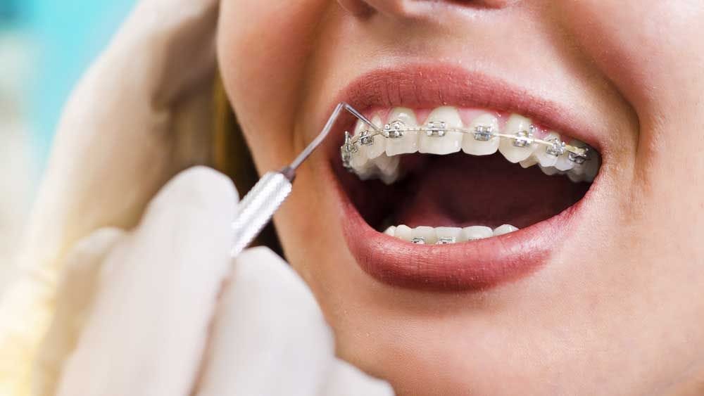 traditional wire braces