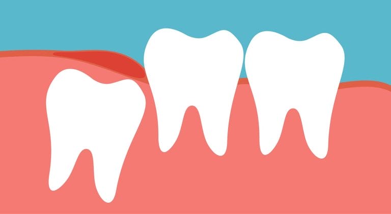 wisdom teeth and molar impaction extraction causes signs symtoms brooklyn new york