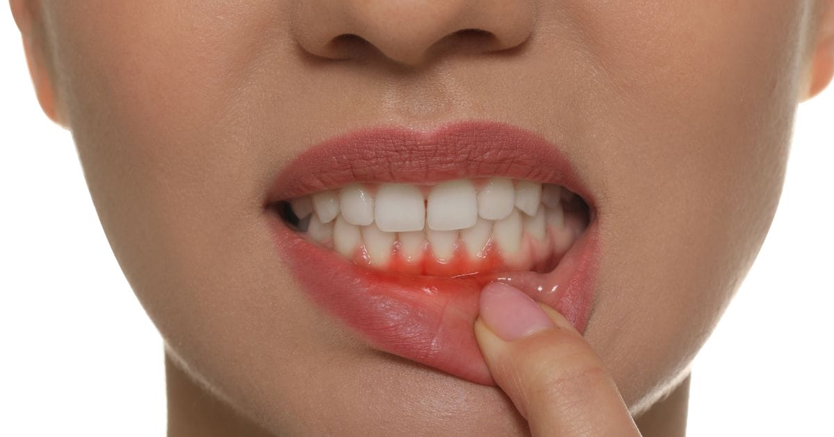Should My Gums Bleed When I Floss? 3V Dental